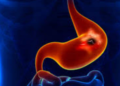 ULCERS: Peptic Ulcer, Causes, Complications, and Control