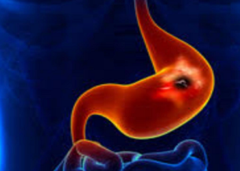 ULCERS: Peptic Ulcer, Causes, Complications, and Control