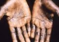 Monkeypox: NCDC activates Emergency Operations Centre