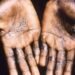 Monkeypox: NCDC activates Emergency Operations Centre